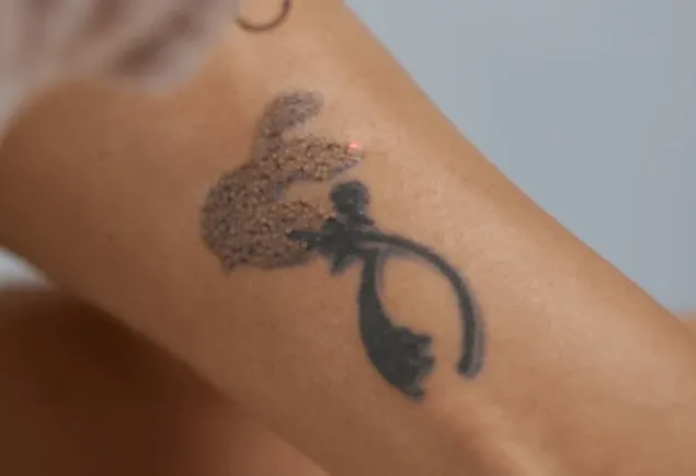 Eliminación de Tatuajes en Málaga y Vélez-Málaga: Recupera la Armonía de Tu Piel